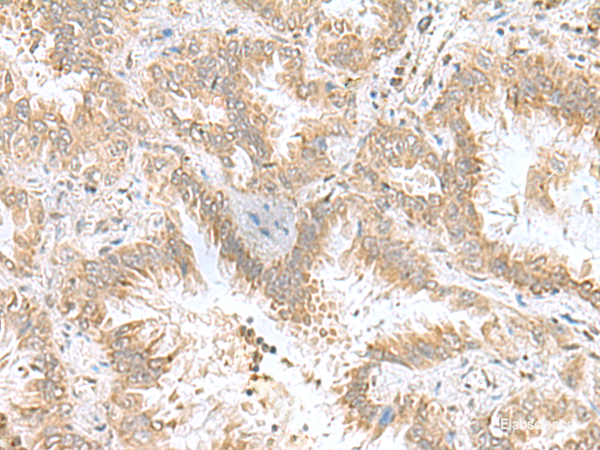 Immunohistochemistry of paraffin-embedded Human lung cancer tissue using CPLX3 Polyclonal Antibody at dilution of 1:55(×200)