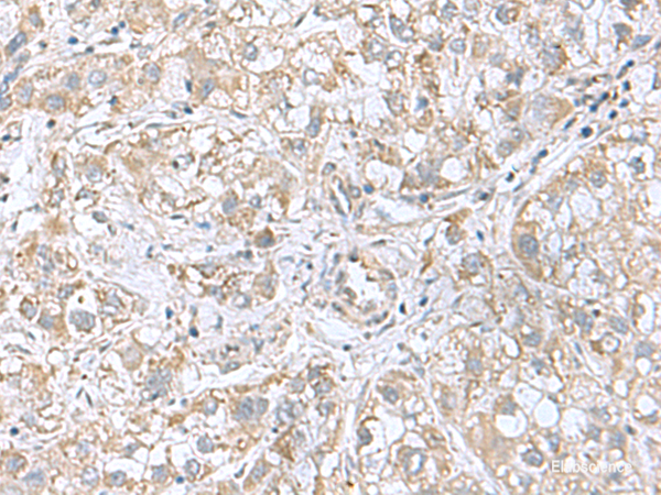 Immunohistochemistry of paraffin-embedded Human liver cancer tissue using CGB5 Polyclonal Antibody at dilution of 1:55(×200)