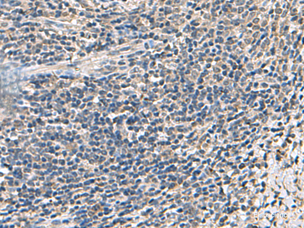 Immunohistochemistry of paraffin-embedded Human cervical cancer tissue using ATP5F1D Polyclonal Antibody at dilution of 1:55(×200)