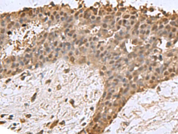 Immunohistochemistry of paraffin-embedded Human breast cancer tissue using DCTPP1 Polyclonal Antibody at dilution of 1:85(×200)