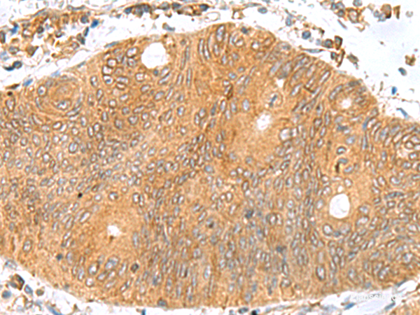 Immunohistochemistry of paraffin-embedded Human colorectal cancer tissue using TXNDC12 Polyclonal Antibody at dilution of 1:70(×200)