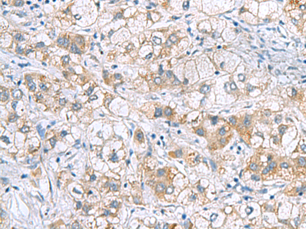 Immunohistochemistry of paraffin-embedded Human liver cancer tissue using GCSH Polyclonal Antibody at dilution of 1:60(×200)