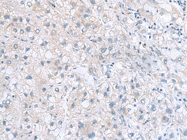 Immunohistochemistry of paraffin-embedded Human liver cancer tissue using MYDGF Polyclonal Antibody at dilution of 1:70(×200)