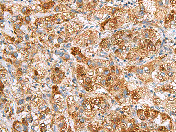 Immunohistochemistry of paraffin-embedded Human liver cancer tissue using NMU Polyclonal Antibody at dilution of 1:80(×200)