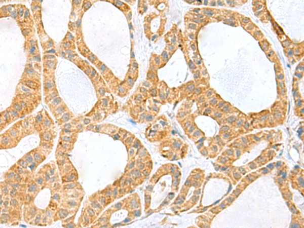 Immunohistochemistry of paraffin-embedded Human thyroid cancer tissue using PPIH Polyclonal Antibody at dilution of 1:60(×200)