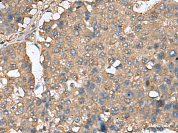 Immunohistochemistry of paraffin-embedded Human liver cancer tissue using EIF4A2 Polyclonal Antibody at dilution of 1:65(×200)