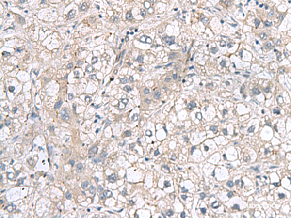 Immunohistochemistry of paraffin-embedded Human liver cancer tissue using RNF208 Polyclonal Antibody at dilution of 1:65(×200)