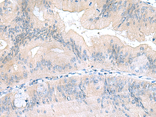 Immunohistochemistry of paraffin-embedded Human colorectal cancer tissue using UBE2F Polyclonal Antibody at dilution of 1:70(×200)