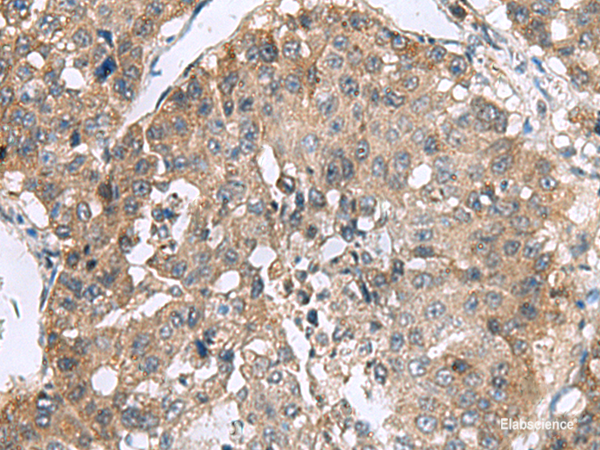 Immunohistochemistry of paraffin-embedded Human liver cancer tissue using RPL18 Polyclonal Antibody at dilution of 1:70(×200)