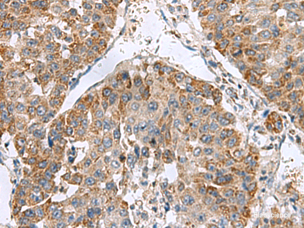 Immunohistochemistry of paraffin-embedded Human liver cancer tissue using NFS1 Polyclonal Antibody at dilution of 1:50(×200)