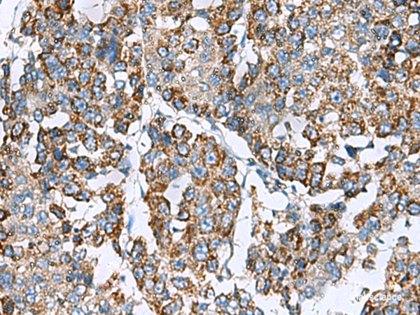 Immunohistochemistry of paraffin-embedded Human liver cancer tissue using PRELID3B Polyclonal Antibody at dilution of 1:90(×200)