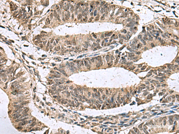 Immunohistochemistry of paraffin-embedded Human colorectal cancer tissue using TMX3 Polyclonal Antibody at dilution of 1:70(×200)