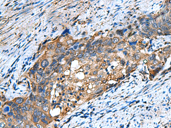 Immunohistochemistry of paraffin-embedded Human cervical cancer tissue using COMMD9 Polyclonal Antibody at dilution of 1:60(×200)