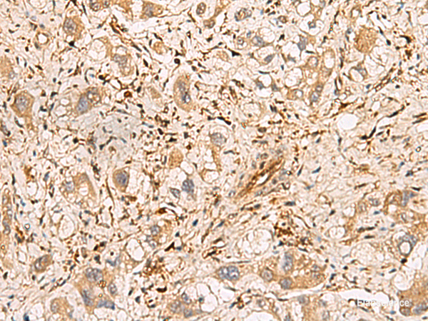Immunohistochemistry of paraffin-embedded Human liver cancer tissue using PLCB2 Polyclonal Antibody at dilution of 1:60(×200)