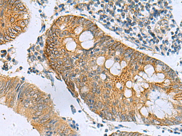 Immunohistochemistry of paraffin-embedded Human colorectal cancer tissue using GUCA1A Polyclonal Antibody at dilution of 1:105(×200)