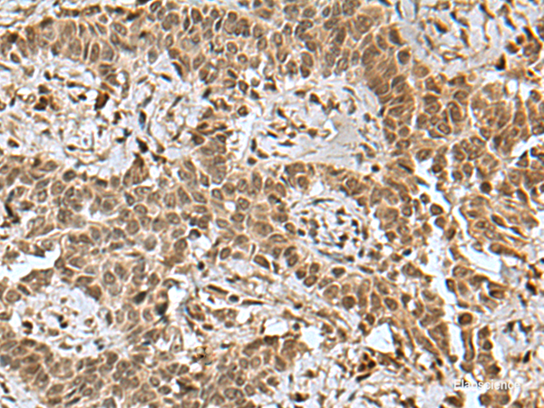 Immunohistochemistry of paraffin-embedded Human ovarian cancer tissue using BCL7B Polyclonal Antibody at dilution of 1:85(×200)