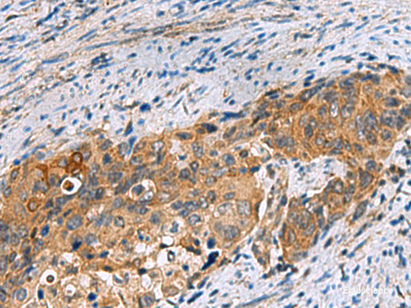 Immunohistochemistry of paraffin-embedded Human cervical cancer tissue using JOSD1 Polyclonal Antibody at dilution of 1:70(×200)