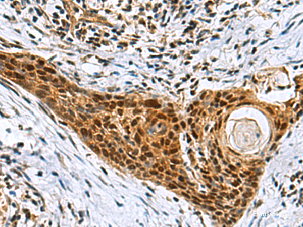 Immunohistochemistry of paraffin-embedded Human esophagus cancer tissue using NABP1 Polyclonal Antibody at dilution of 1:80(×200)