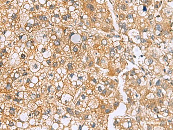 Immunohistochemistry of paraffin-embedded Human liver cancer tissue using MRPL22 Polyclonal Antibody at dilution of 1:50(×200)