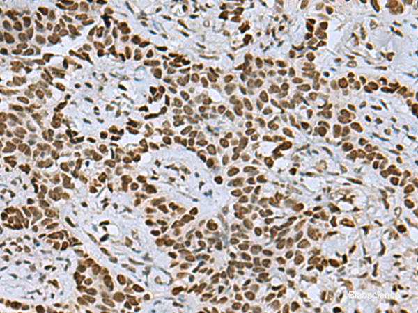 Immunohistochemistry of paraffin-embedded Human ovarian cancer tissue using MYEF2 Polyclonal Antibody at dilution of 1:55(×200)