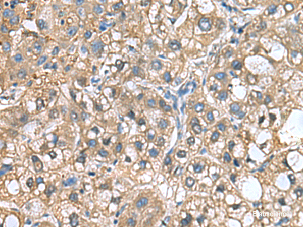 Immunohistochemistry of paraffin-embedded Human liver cancer tissue using IGLL1 Polyclonal Antibody at dilution of 1:65(×200)