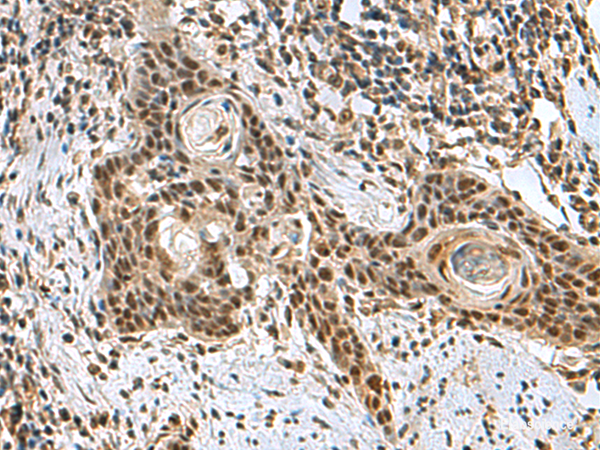 Immunohistochemistry of paraffin-embedded Human esophagus cancer tissue using PRPF40A Polyclonal Antibody at dilution of 1:60(×200)