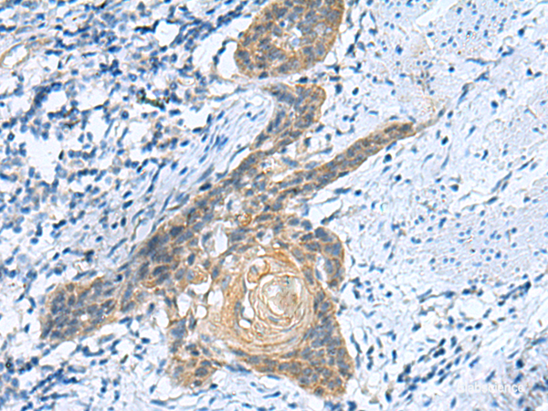 Immunohistochemistry of paraffin-embedded Human esophagus cancer tissue using GINS3 Polyclonal Antibody at dilution of 1:50(×200)