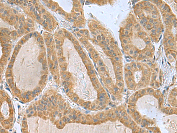 Immunohistochemistry of paraffin-embedded Human thyroid cancer tissue using SLC30A6 Polyclonal Antibody at dilution of 1:75(×200)