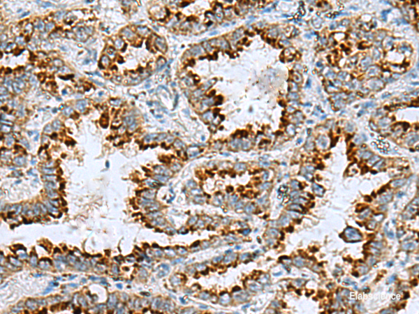 Immunohistochemistry of paraffin-embedded Human lung cancer tissue using FAAP100 Polyclonal Antibody at dilution of 1:85(×200)