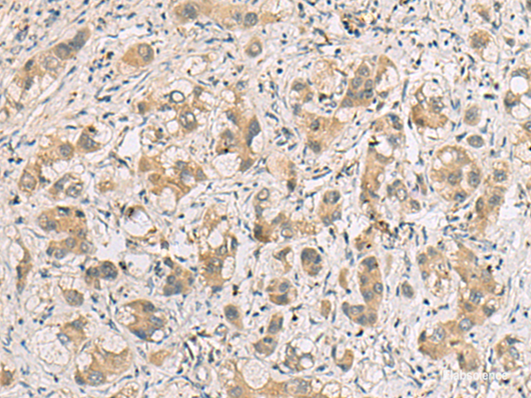 Immunohistochemistry of paraffin-embedded Human liver cancer tissue using RTP4 Polyclonal Antibody at dilution of 1:80(×200)