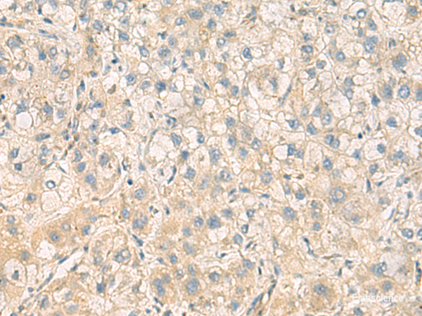 Immunohistochemistry of paraffin-embedded Human liver cancer tissue using PPM1M Polyclonal Antibody at dilution of 1:100(×200)