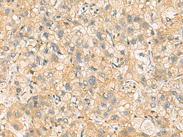 Immunohistochemistry of paraffin-embedded Human liver cancer tissue using NANP Polyclonal Antibody at dilution of 1:65(×200)