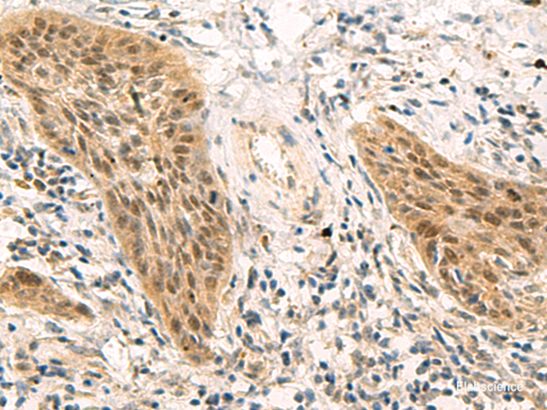 Immunohistochemistry of paraffin-embedded Human esophagus cancer tissue using PSME1 Polyclonal Antibody at dilution of 1:50(×200)