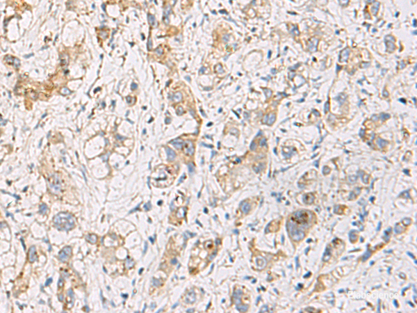 Immunohistochemistry of paraffin-embedded Human liver cancer tissue using FYCO1 Polyclonal Antibody at dilution of 1:110(×200)