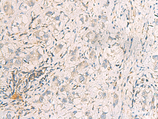 Immunohistochemistry of paraffin-embedded Human liver cancer tissue using SUSD3 Polyclonal Antibody at dilution of 1:95(×200)