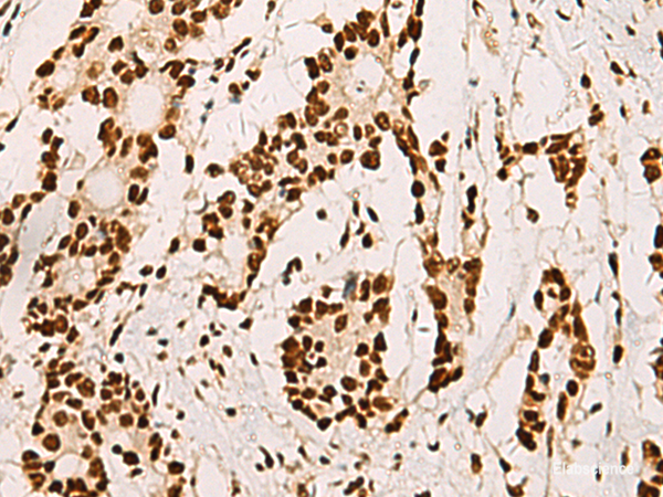 Immunohistochemistry of paraffin-embedded Human colorectal cancer tissue using ELF5 Polyclonal Antibody at dilution of 1:70(×200)