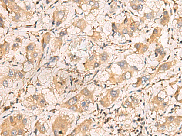 Immunohistochemistry of paraffin-embedded Human liver cancer tissue using TNNT1 Polyclonal Antibody at dilution of 1:75(×200)