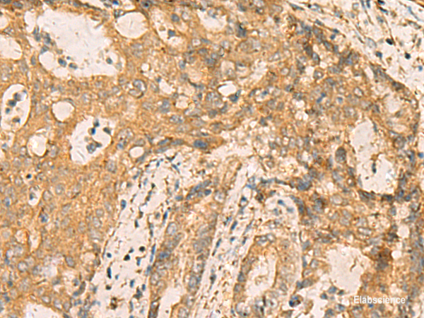 Immunohistochemistry of paraffin-embedded Human cervical cancer tissue using CNST Polyclonal Antibody at dilution of 1:70(×200)
