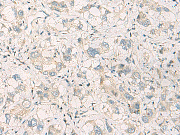 Immunohistochemistry of paraffin-embedded Human liver cancer tissue using SPSB2 Polyclonal Antibody at dilution of 1:70(×200)