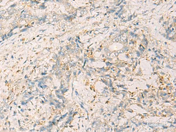 Immunohistochemistry of paraffin-embedded Human cervical cancer tissue using WDR37 Polyclonal Antibody at dilution of 1:50(×200)