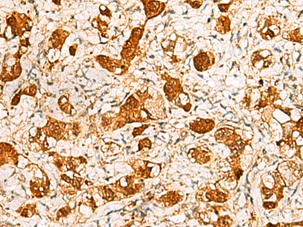 Immunohistochemistry of paraffin-embedded Human liver cancer tissue using C11orf54 Polyclonal Antibody at dilution of 1:50(×200)