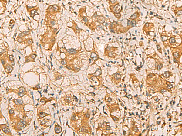 Immunohistochemistry of paraffin-embedded Human liver cancer tissue using MRPL9 Polyclonal Antibody at dilution of 1:55(×200)