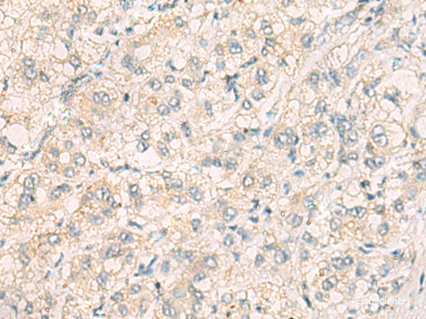 Immunohistochemistry of paraffin-embedded Human liver cancer tissue using THG1L Polyclonal Antibody at dilution of 1:70(×200)