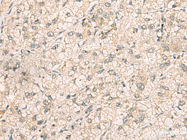 Immunohistochemistry of paraffin-embedded Human liver cancer tissue using TTLL5 Polyclonal Antibody at dilution of 1:70(×200)