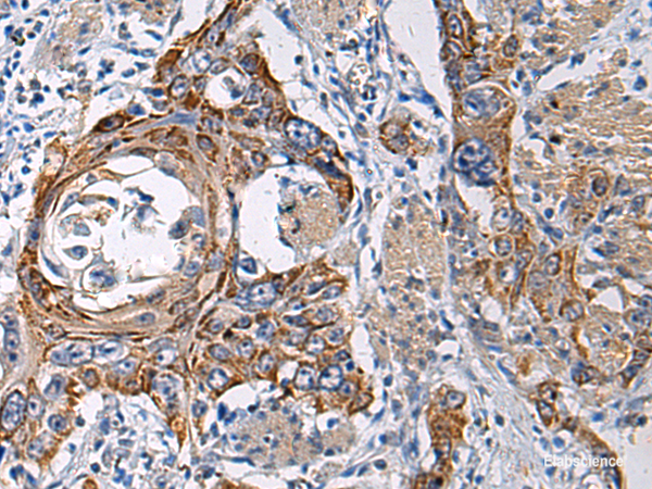 Immunohistochemistry of paraffin-embedded Human esophagus cancer tissue using RITA1 Polyclonal Antibody at dilution of 1:60(×200)