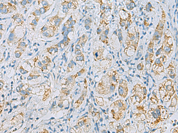 Immunohistochemistry of paraffin-embedded Human liver cancer tissue using PLA2G15 Polyclonal Antibody at dilution of 1:65(×200)
