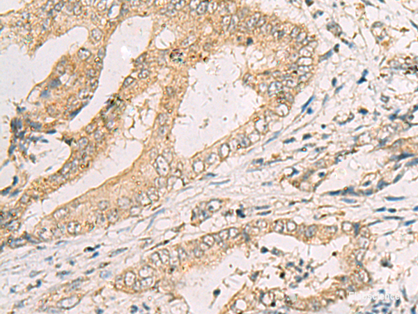 Immunohistochemistry of paraffin-embedded Human cervical cancer tissue using SPACA1 Polyclonal Antibody at dilution of 1:50(×200)