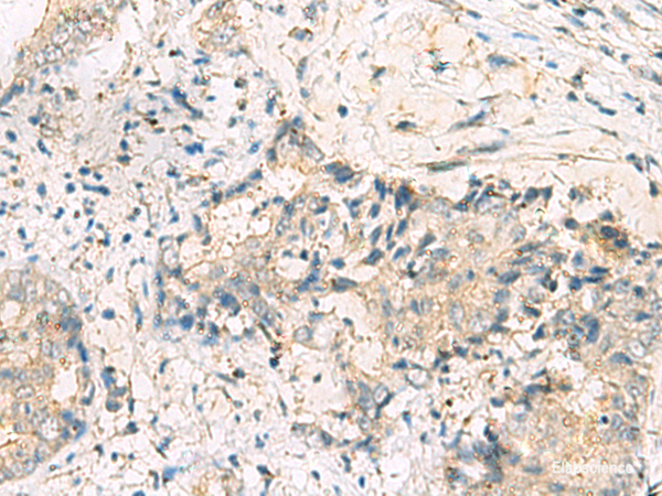 Immunohistochemistry of paraffin-embedded Human cervical cancer tissue using MGAT4B Polyclonal Antibody at dilution of 1:50(×200)