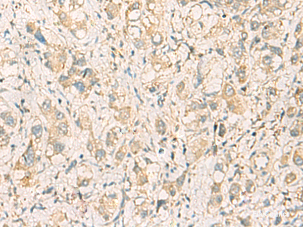 Immunohistochemistry of paraffin-embedded Human liver cancer tissue using F11R Polyclonal Antibody at dilution of 1:40(×200)