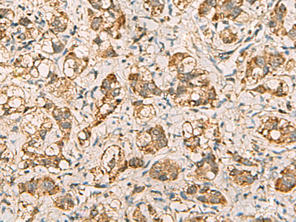 Immunohistochemistry of paraffin-embedded Human liver cancer tissue using VTA1 Polyclonal Antibody at dilution of 1:60(×200)